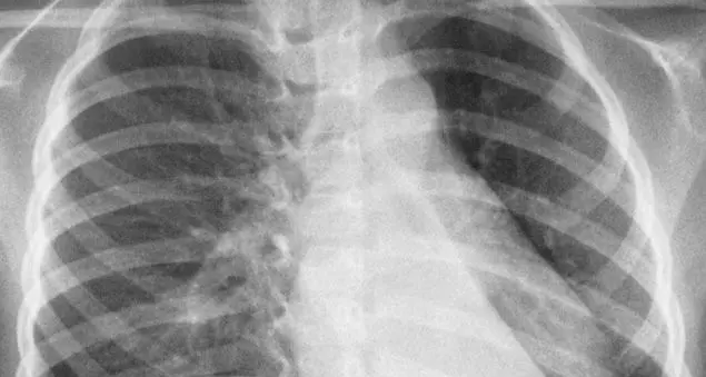 Polmonite, come riconoscere i primi sintomi