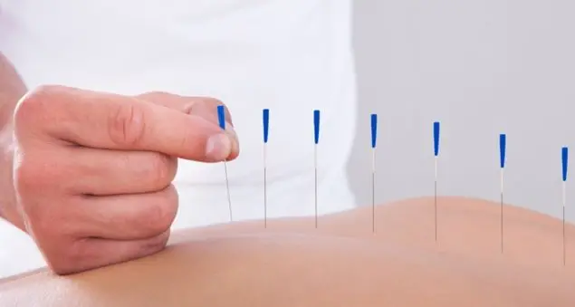 Agopuntura: vero e falso