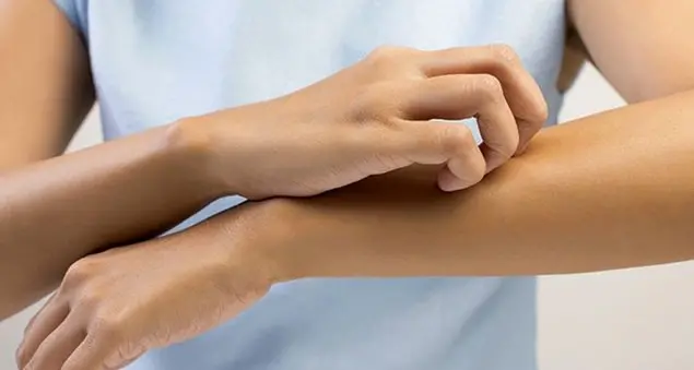 Dermatite atopica, come evitare il prurito