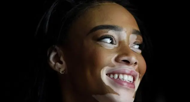 Vitiligine: quelle macchie non sono una condanna. Le tecniche per trattarle