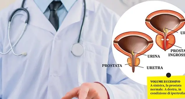 Prostata ingrossata: il segreto della cura senza bisturi
