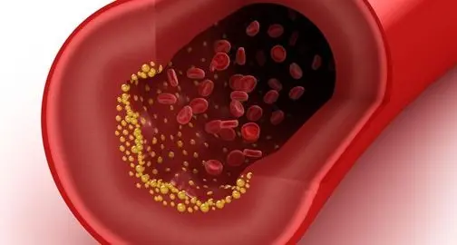Colesterolo alto: nuova terapia combinata