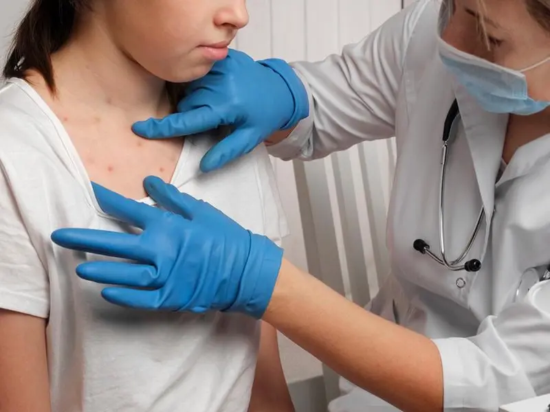 Morbillo, aumentano i casi in Italia: chi rischia di più e come proteggersi