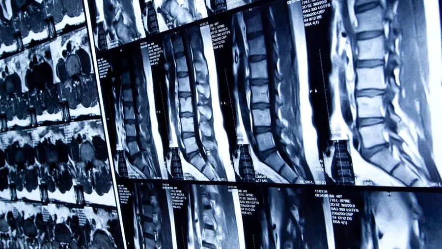 Cisti sinoviali: cause, sintomi, diagnosi e cure